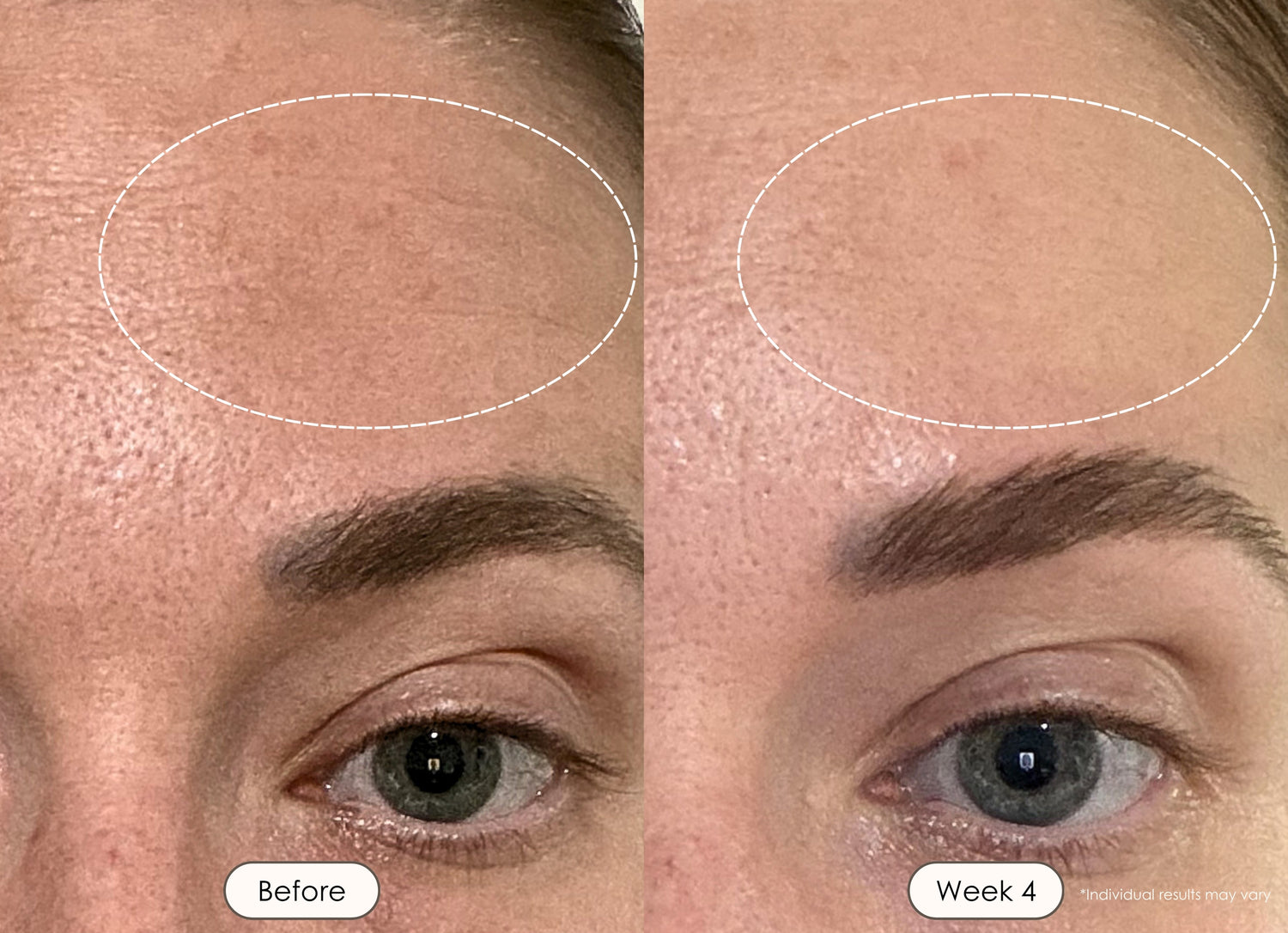 Before and after skincare results of a woman showing smoother forehead skin after 4 weeks.
